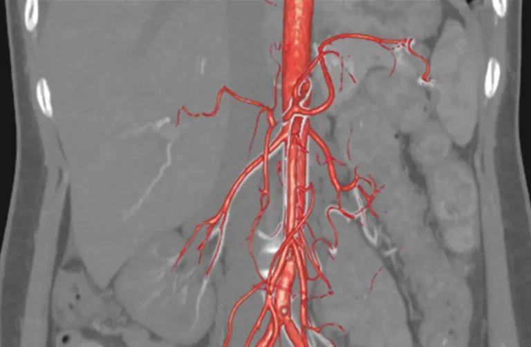 CT Slice: Radiologists’ Role in Diagnosing Aortic Dissection