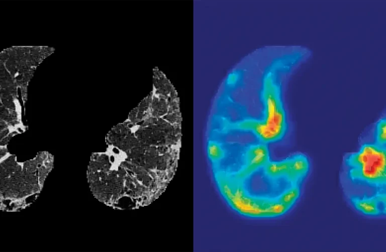 AI News: New Consortium Takes Aim at IPF