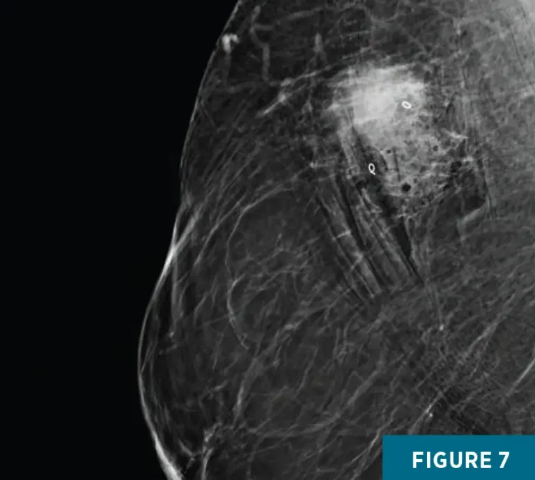 On the Case: Rosai-Dorfman Disease of the Breast